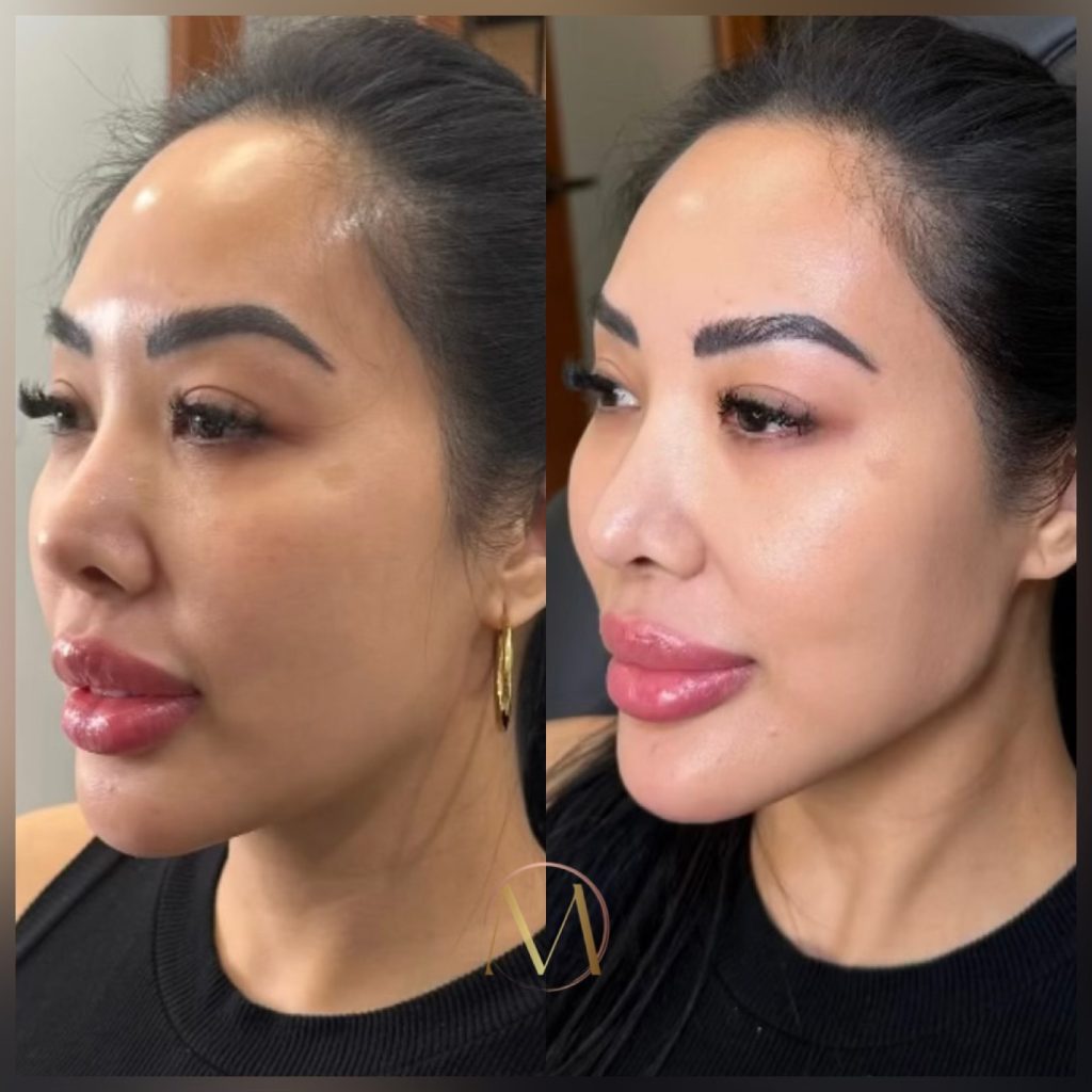 Enhanced jawline definition after filler procedure.