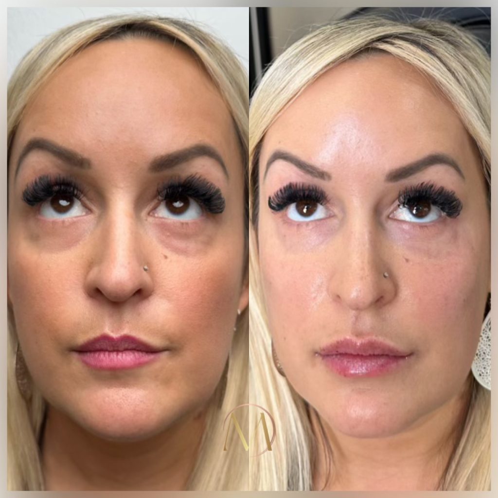 Before and after images of tear trough filler treatment.